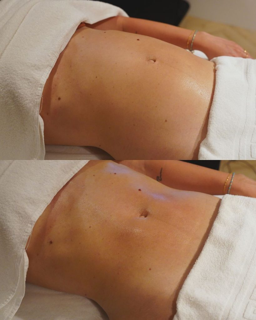 Antes y después del tratamiento indiba corporal de LeMulier